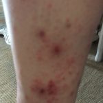 jambe piquée à plusieurs reprises par la punaise de lit lyonnaise